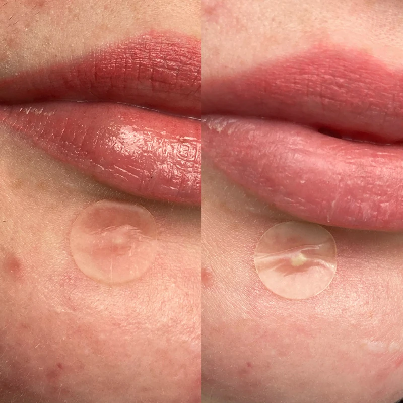 Náplasť proti akné Hero Cosmetics Mighty Patch Duo