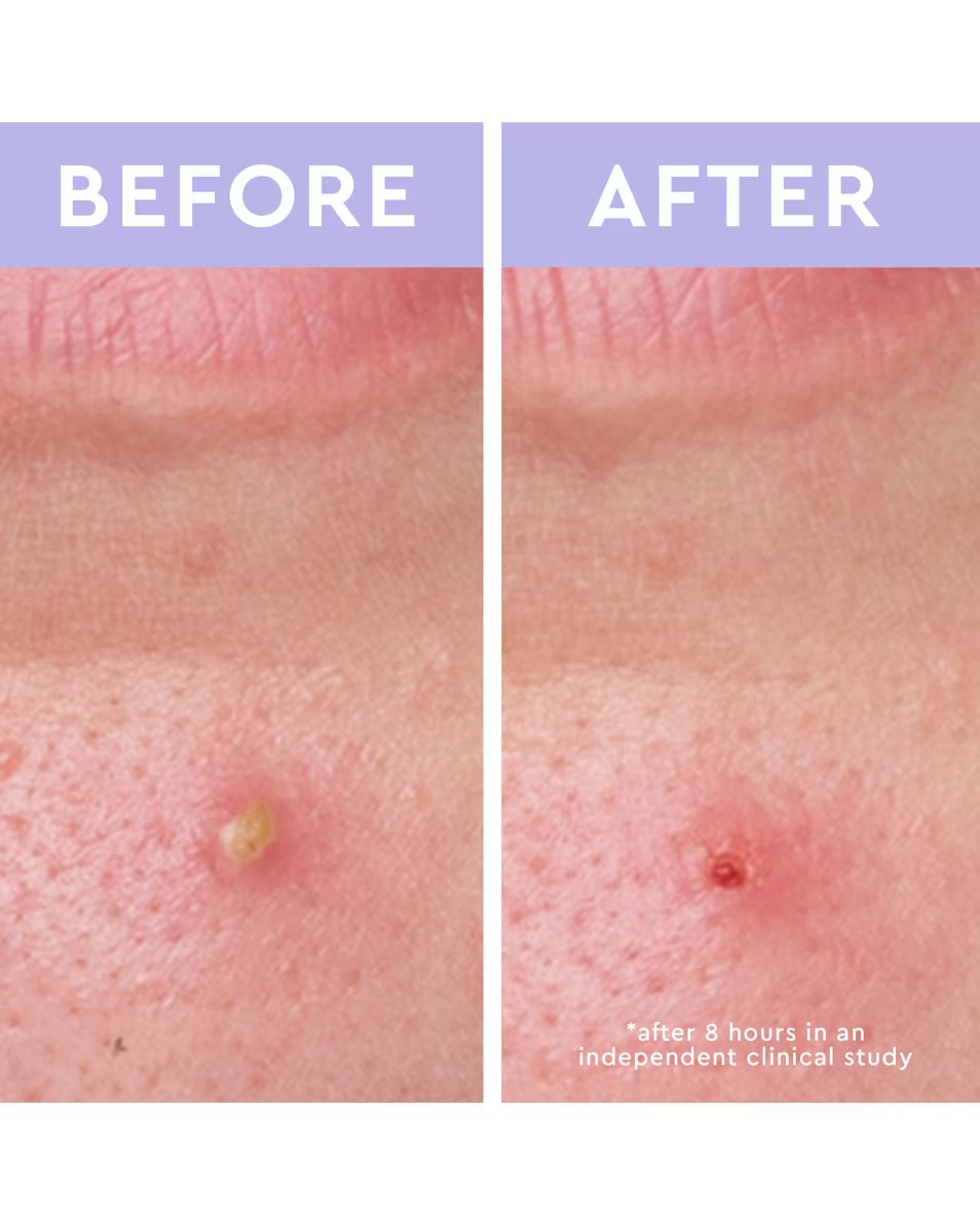 FLORENCE BY MILLS PATCHES SPOT A SPOT BLEMISH