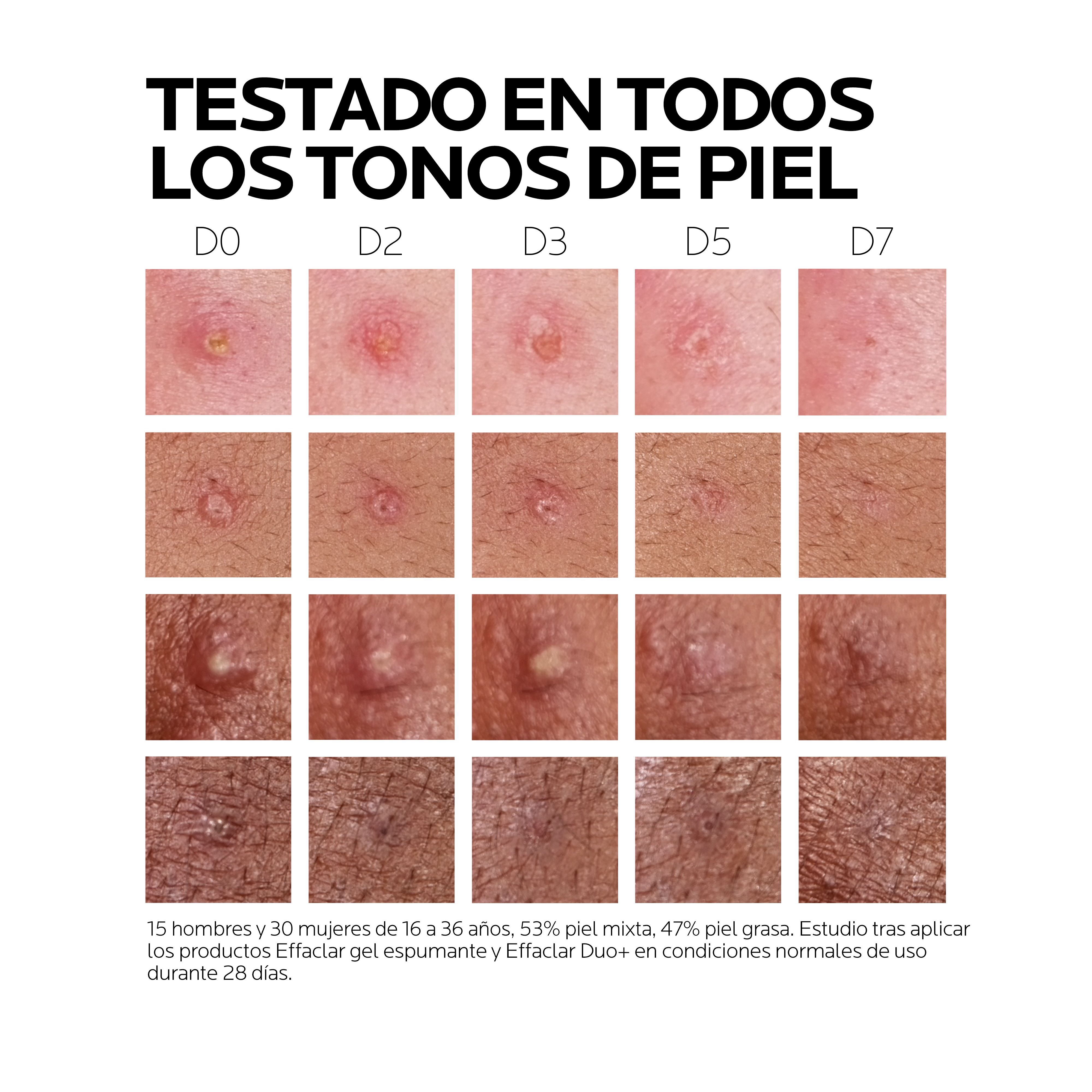 Effaclar Duo M tretmani za akne