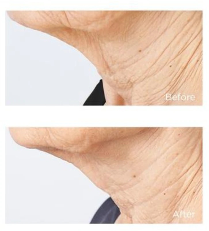 Perricone MD Cold Plasma Plus+ Sub-D/Neck krema za učvrstitev vratu in dekolteja