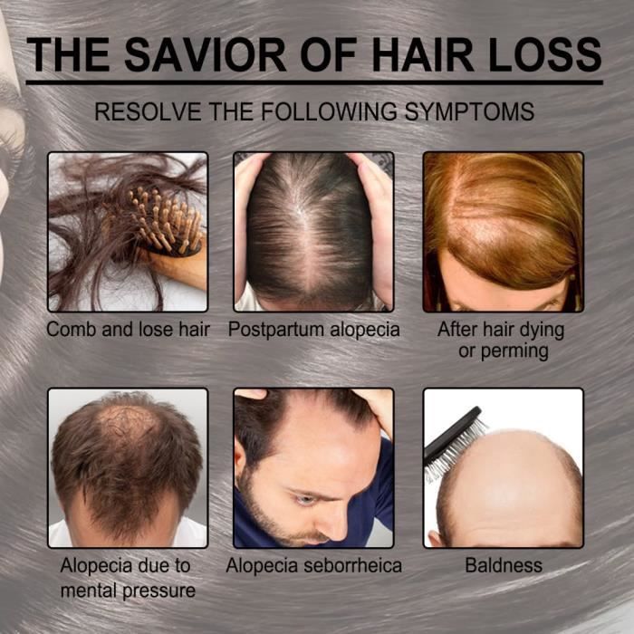 Aceite esencial de romero para el cuidado del cabello: previene la rotura y favorece el crecimiento del cabello.