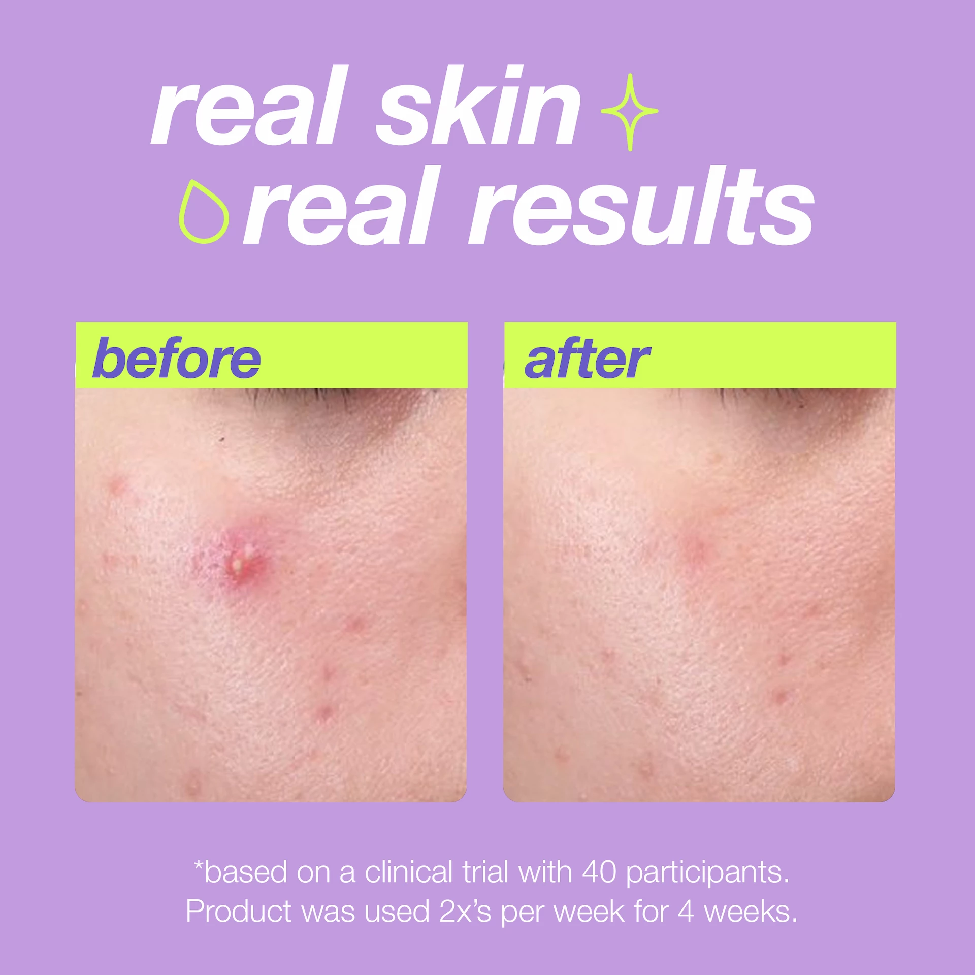 Pattanástisztító folyékony hámlasztó 30 ml - Dermalogica