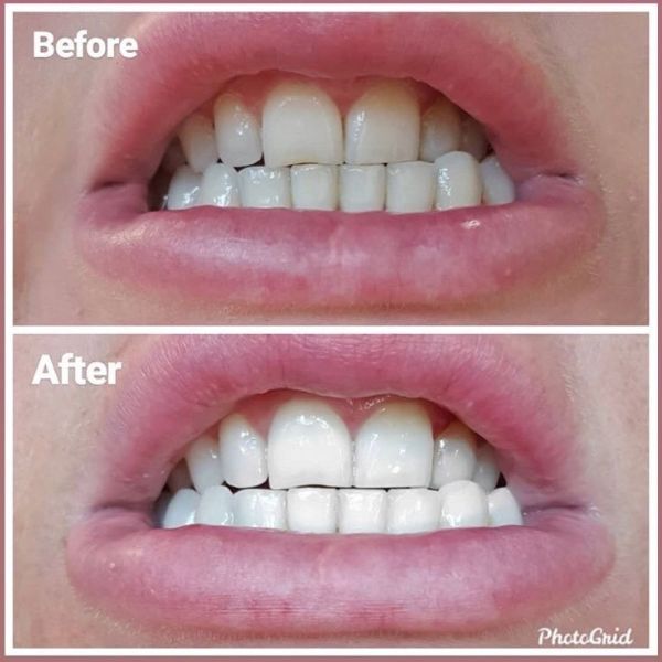 SmileTime ST01 Zahnfleckenentferner
