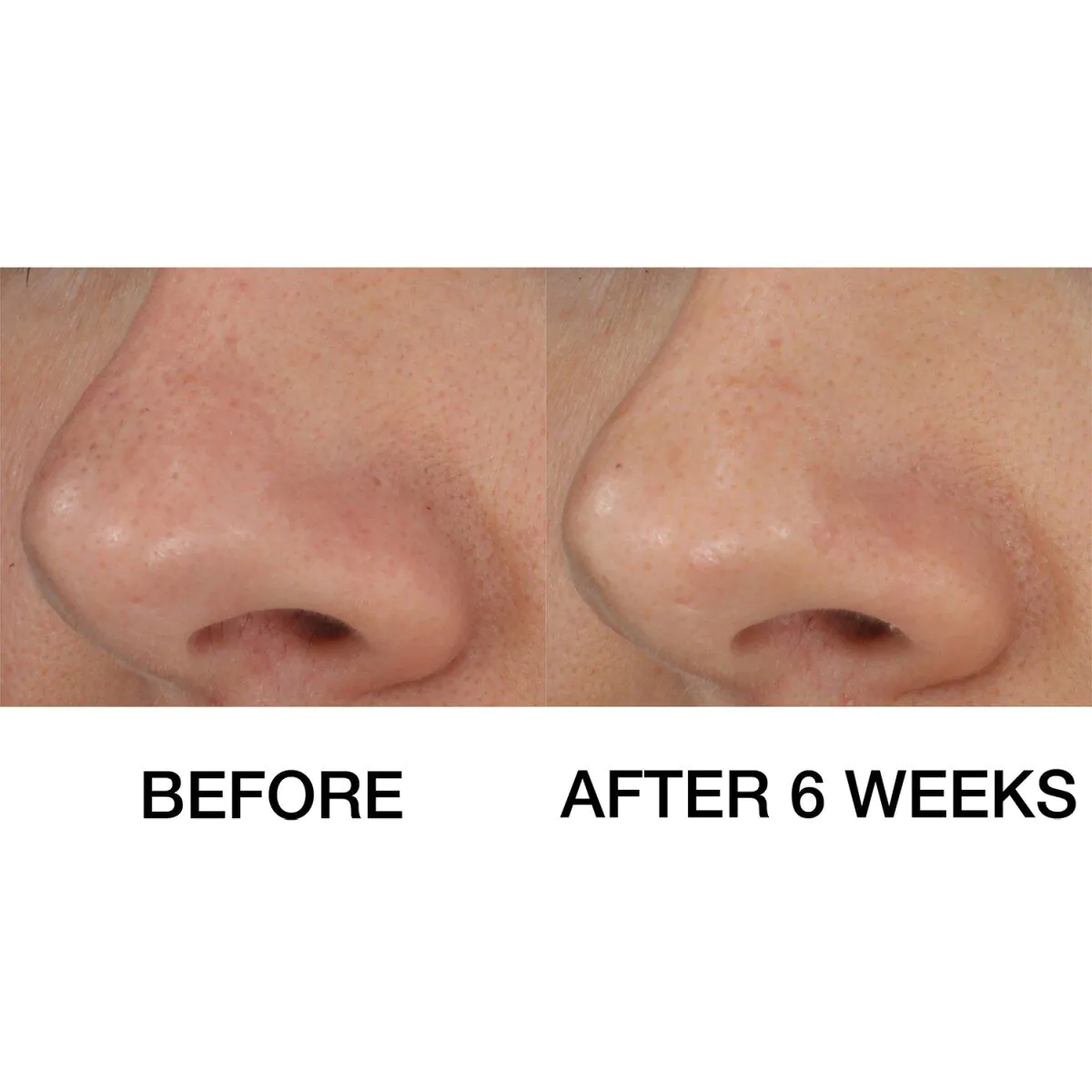 Clinique Blackhead Solutions Self-heating Blackhead Extraxtor Żel oczyszczający