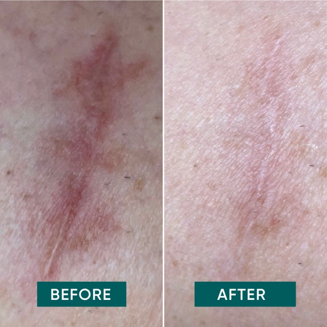 Apricot Body Care 1h APRICOT Višekratni jastučići za ožiljke s aloe verom - 2 g