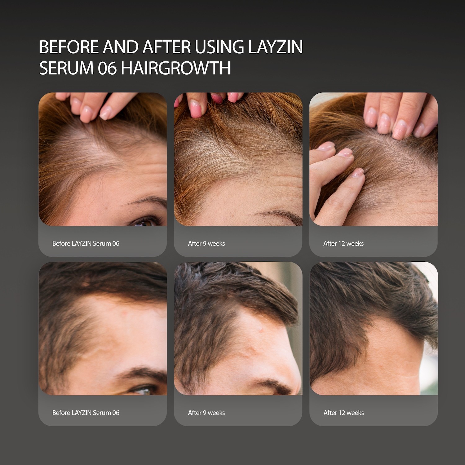 LAYZIN Haarwachs-Set für Haarwachstum – Wirksam gegen Haarausfall, fördert das Haarwachstum – 1 Stück