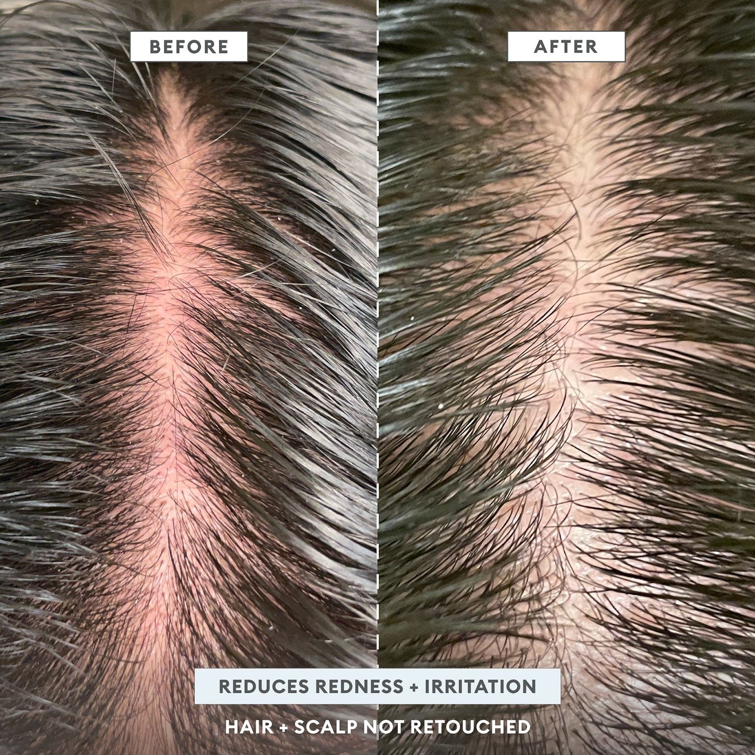 Briogeo Scalp Revival™ MegaStrength+ Šampón proti lupinám s aktívnym uhlím + AHA/BHA a 3 % kyselinou salicylovou – 248 ml