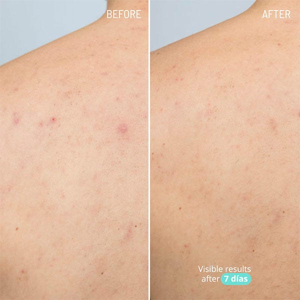 Azelain Active porcápoló krém | 100 ml