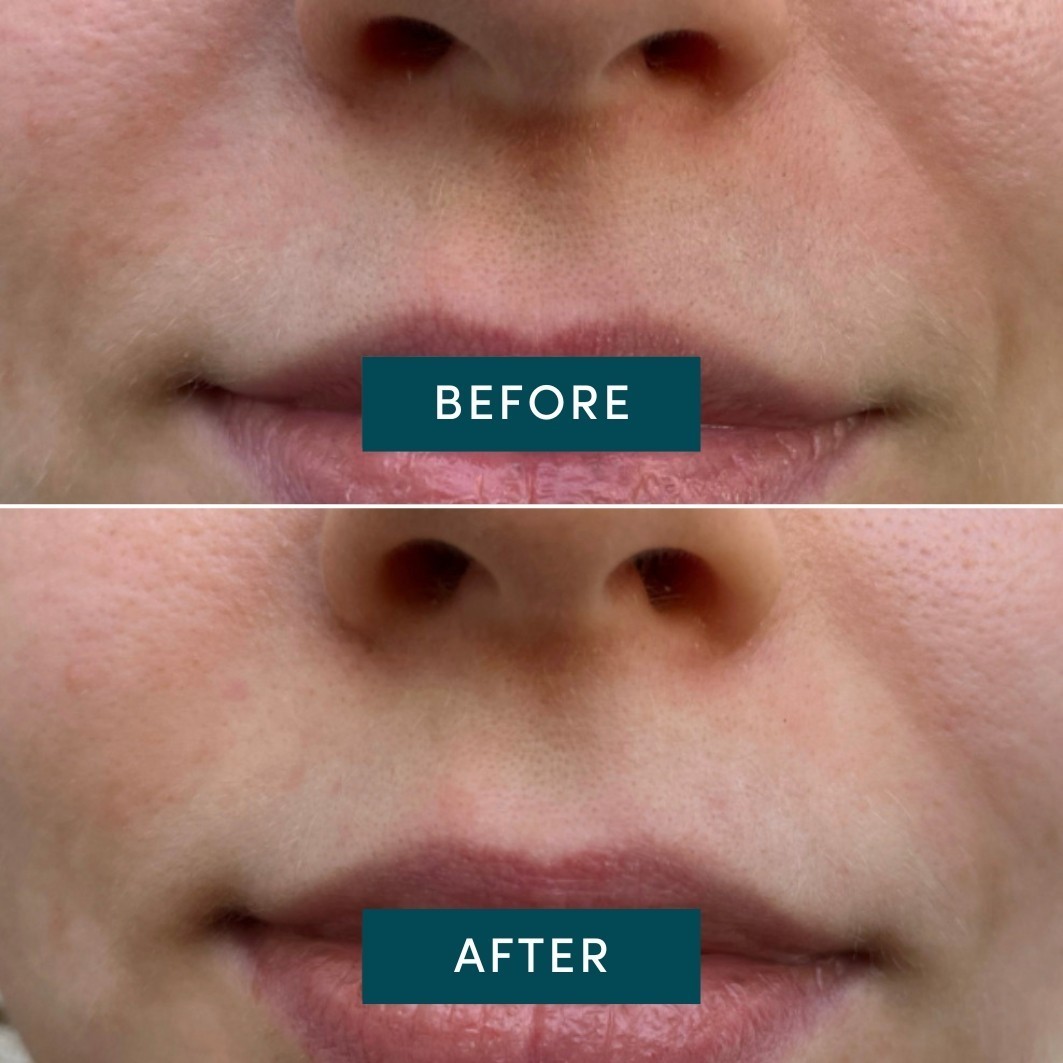 Aprikosen-Anti-Aging-Mundpflaster Ectoin - 100 Stück
