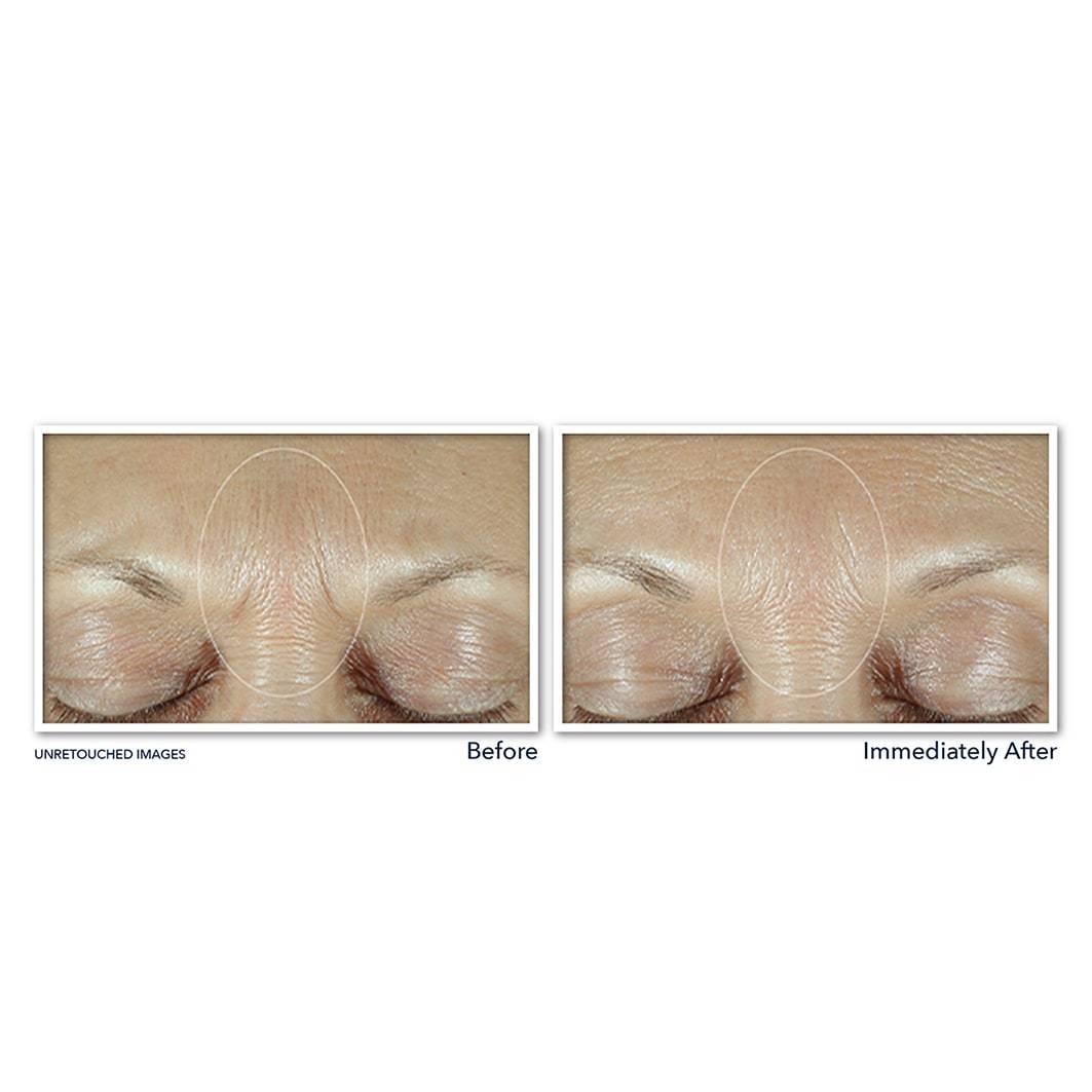 RoC Serum protiv starenja Derm Correxion Fill + Treat Serum - 15 ml