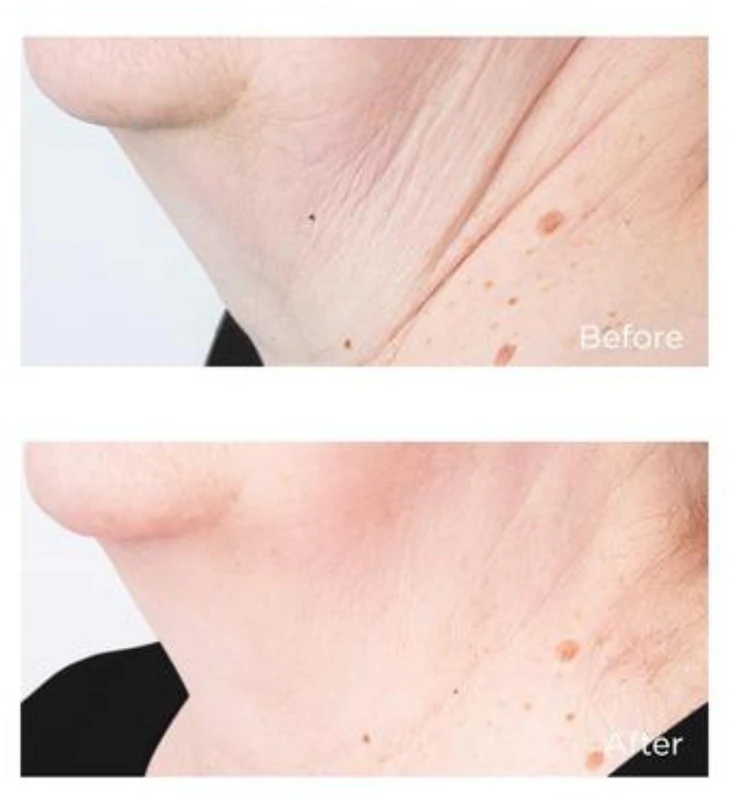 Perricone MD Cold Plasma Plus+ Sub-D/Neck Straffende Creme für Hals und Dekolleté