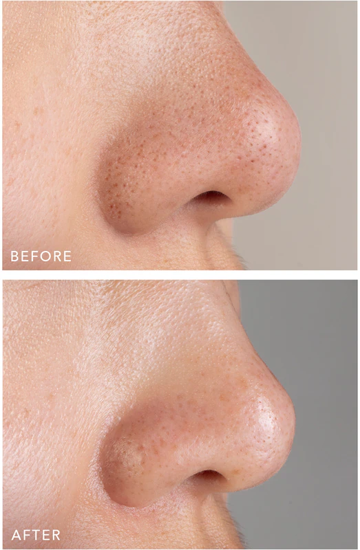 Máscara FOREO KIWI™ Active Pore & Blackhead