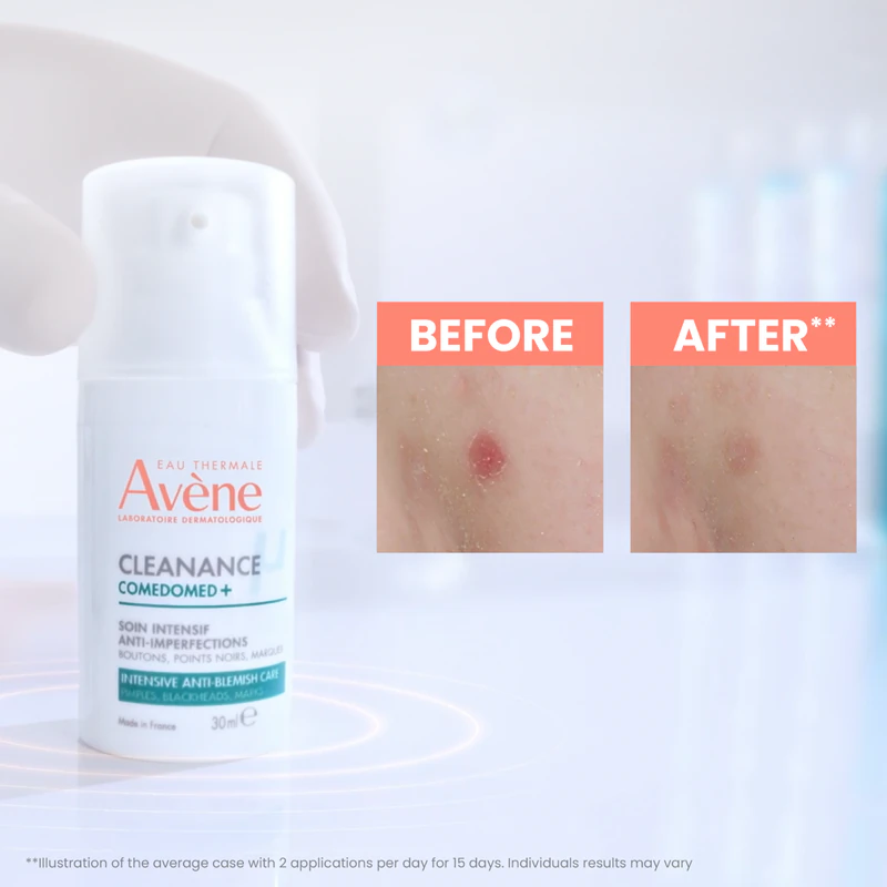 Avène Cleanance Comedomed+ intensieve verzorging tegen acnegevoelige huidonzuiverheden