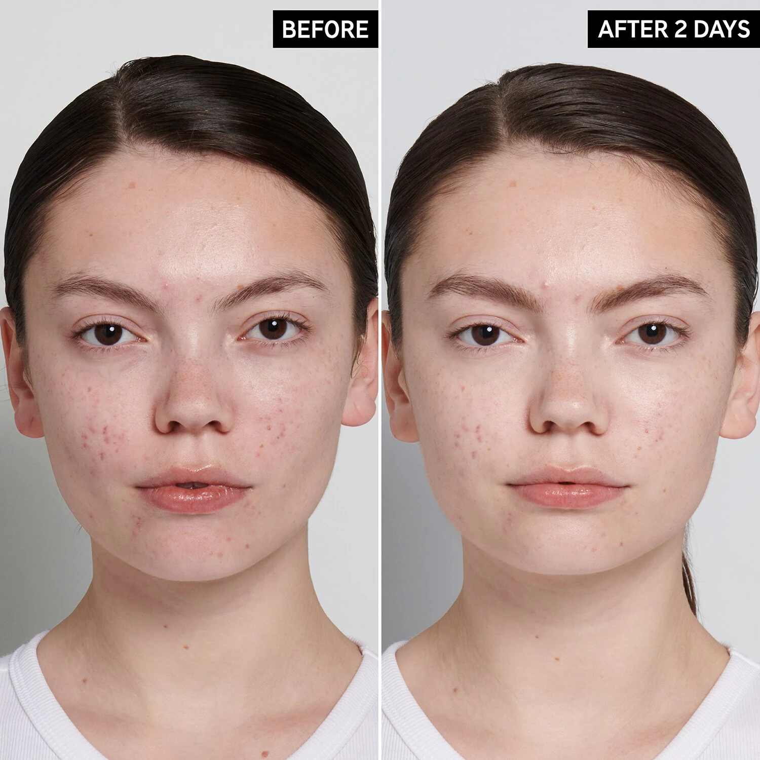 Tratament anti-imperfecțiuni cu acid succinic