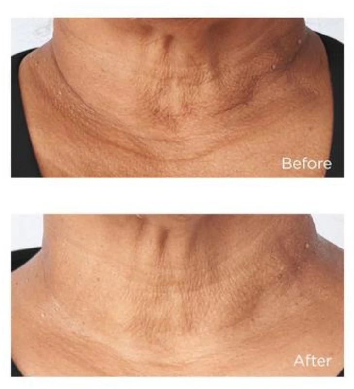 Perricone MD Cold Plasma Plus+ Sub-D/Neck крема за учвршћивање врата и деколтеа