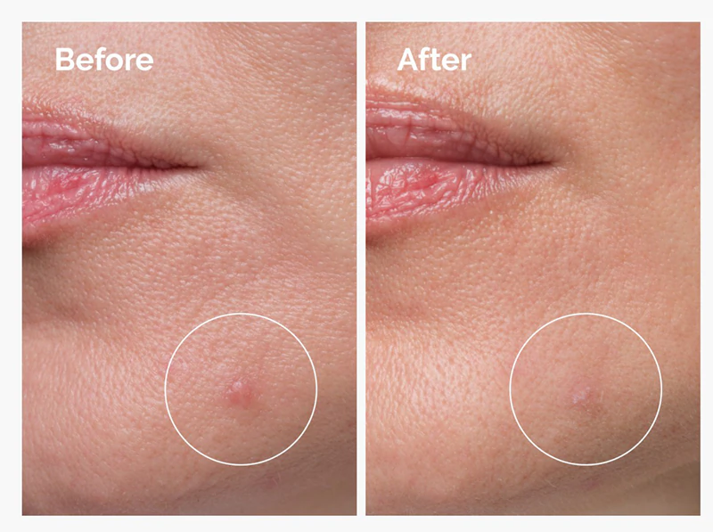 Tratamento localizado antiacne The Ordinary Sulfur 10% Powder-to-Cream Concentrate