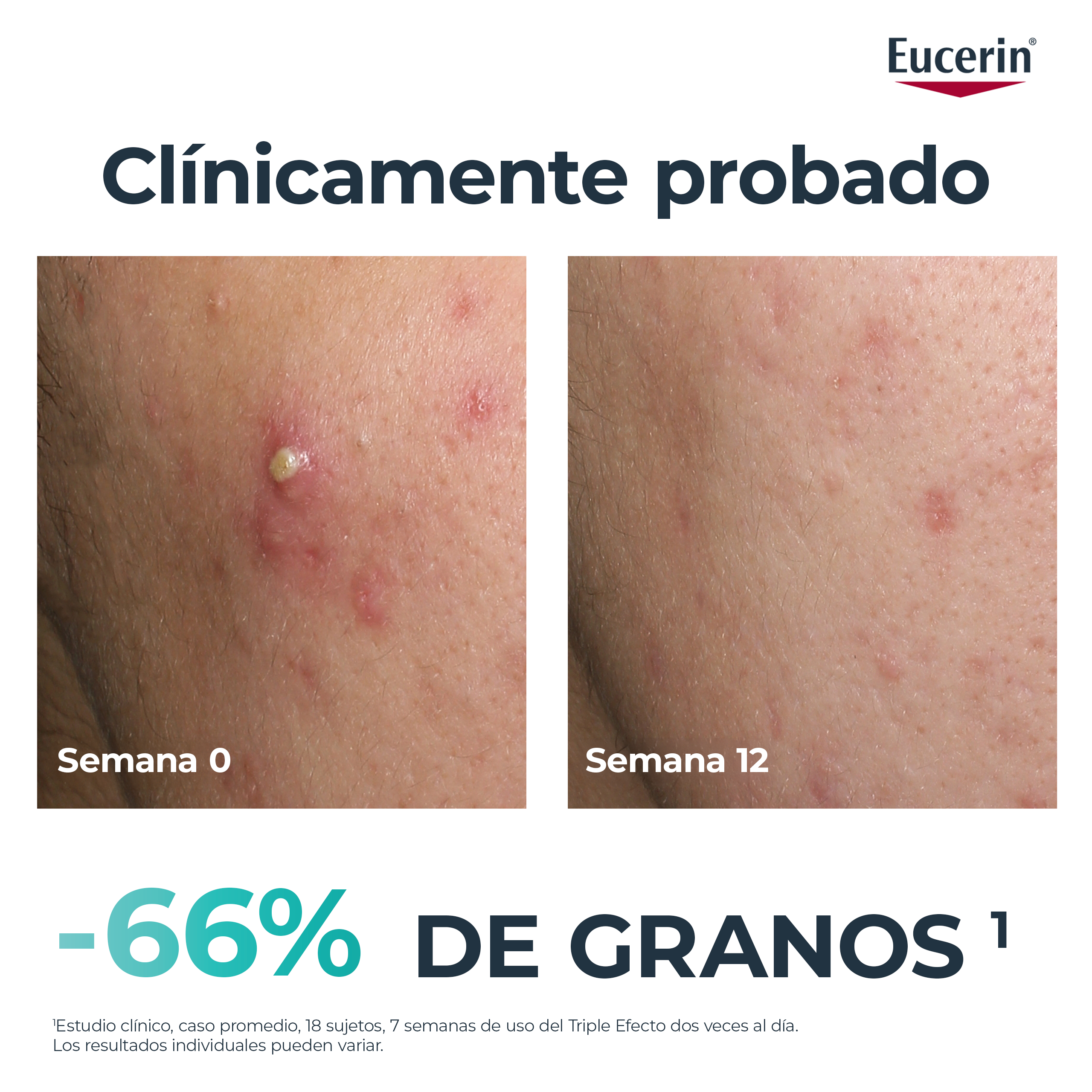 DermoPure klinički serum trostrukog djelovanja Tretmani akni