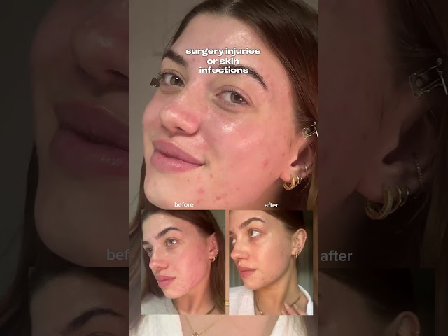Superdrug Narbengel 19 g