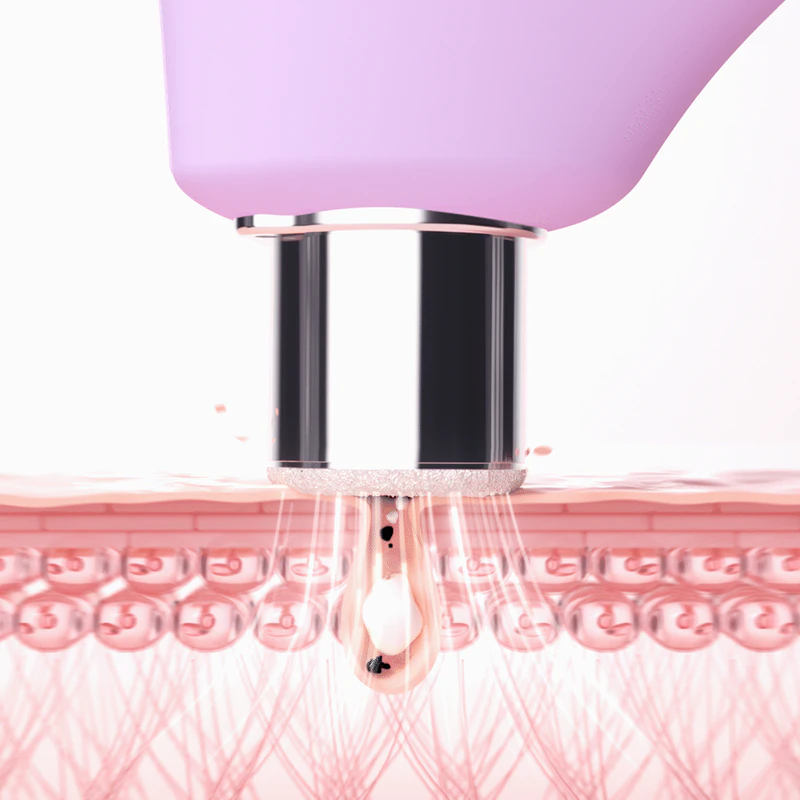 Prístroj FOREO KIWI™ Derma na diamantovú mikrodermabráziu a hĺbkové čistenie tváre