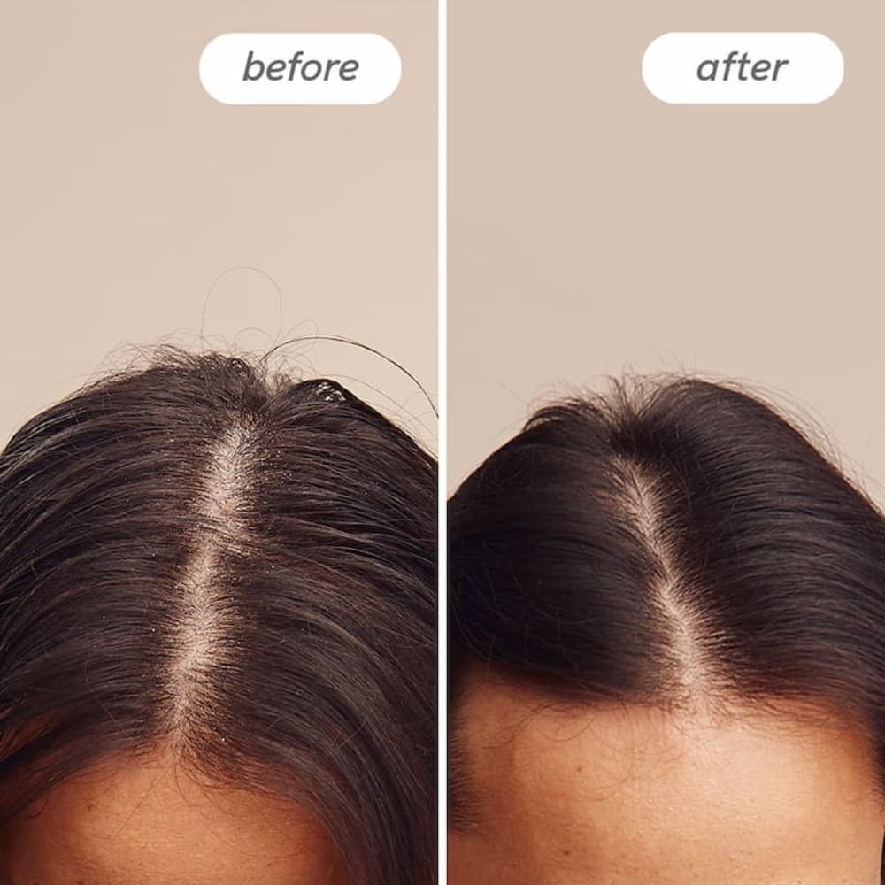 Hairlust Dandruff Shampoo