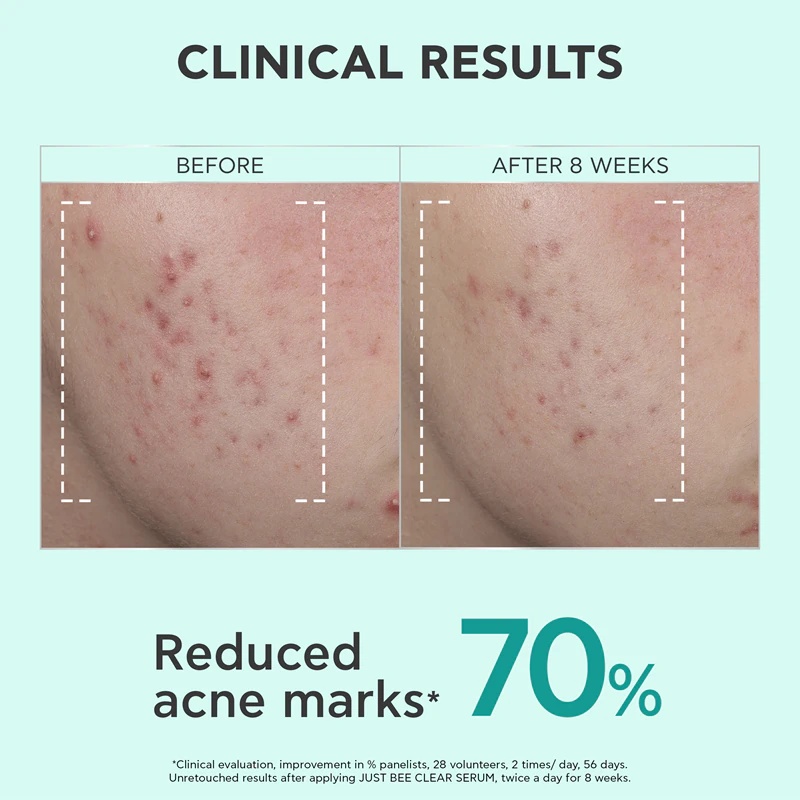 Apivita Just Bee Clear Serum serum za mastno in problematično kožo