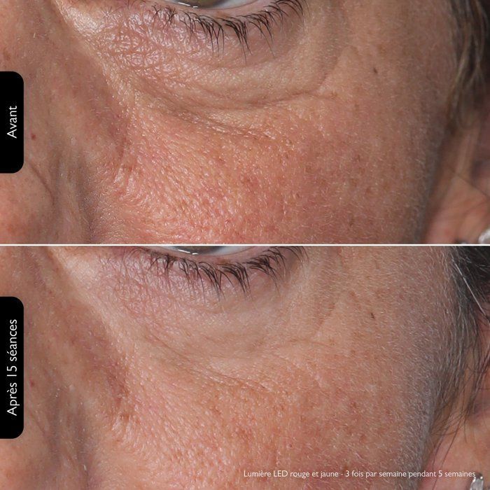 Masque Led Luminotherapie Silk'n Lumino - 100leds - Anti-âge / Anti-imperfections