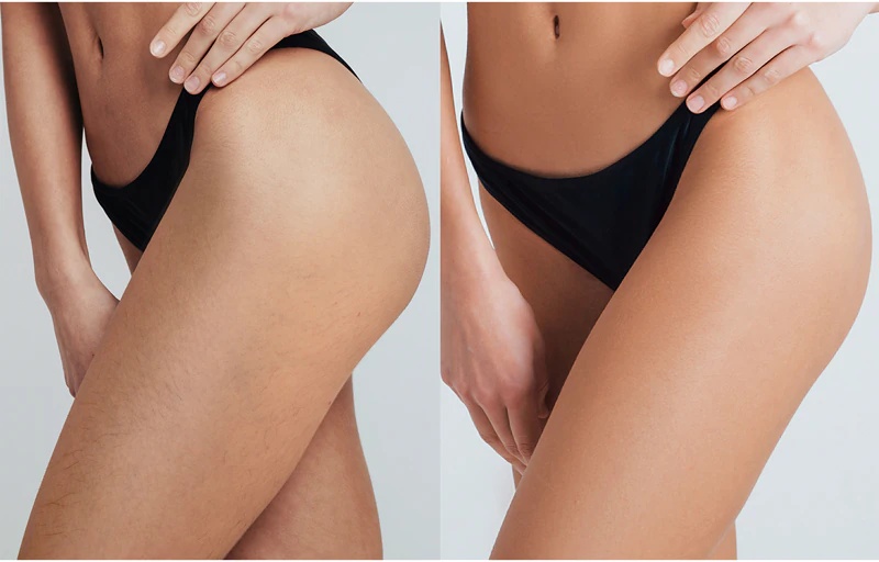 FOREO PEACH™ 2 Pro Max IPL kūnui, veidui, bikinio sričiai ir pažastims moterims