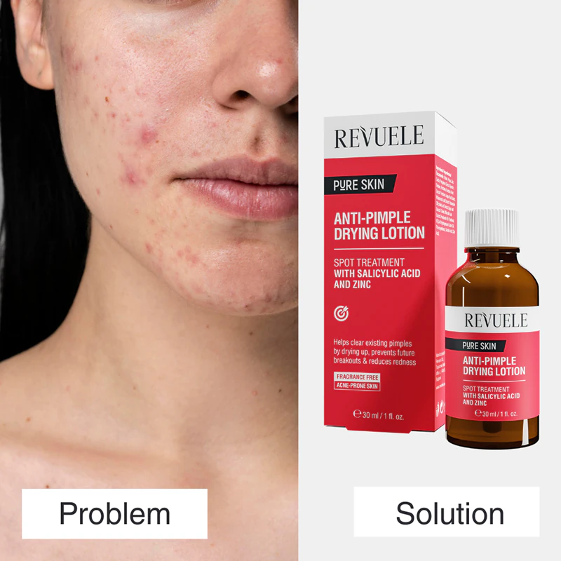 Revuele Pure Skin Anti-Pimple, tratamento tópico para acne.