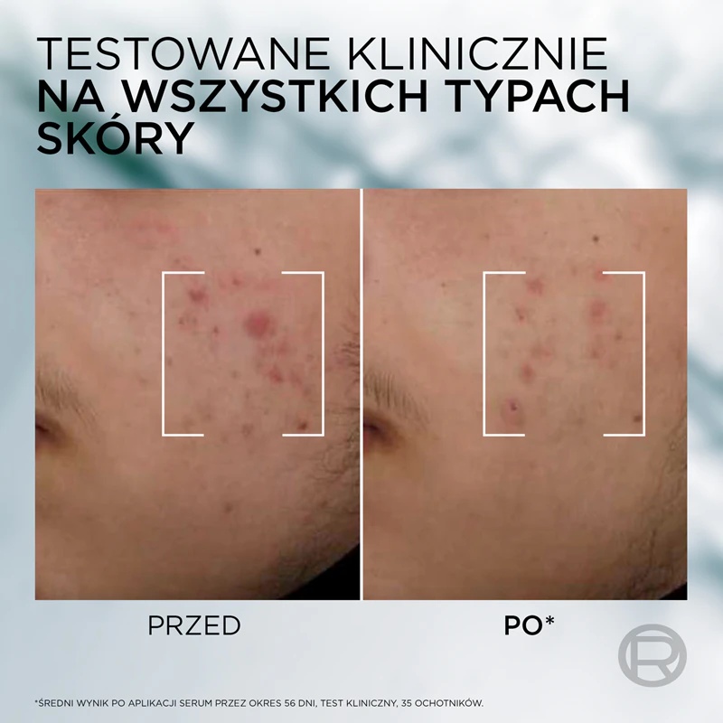 L'Oréal Paris Men Expert Derma Control serum proti nepravilnostim na koži