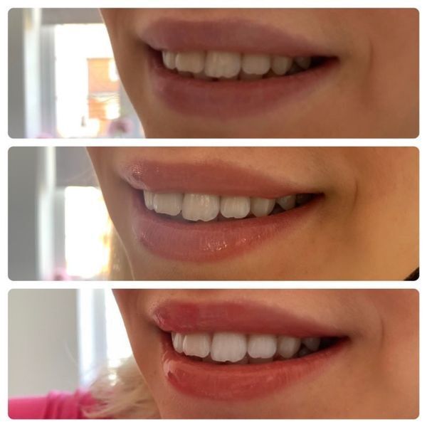 SmileTime Premium PAP -hampaidenvalkaisuliuskat