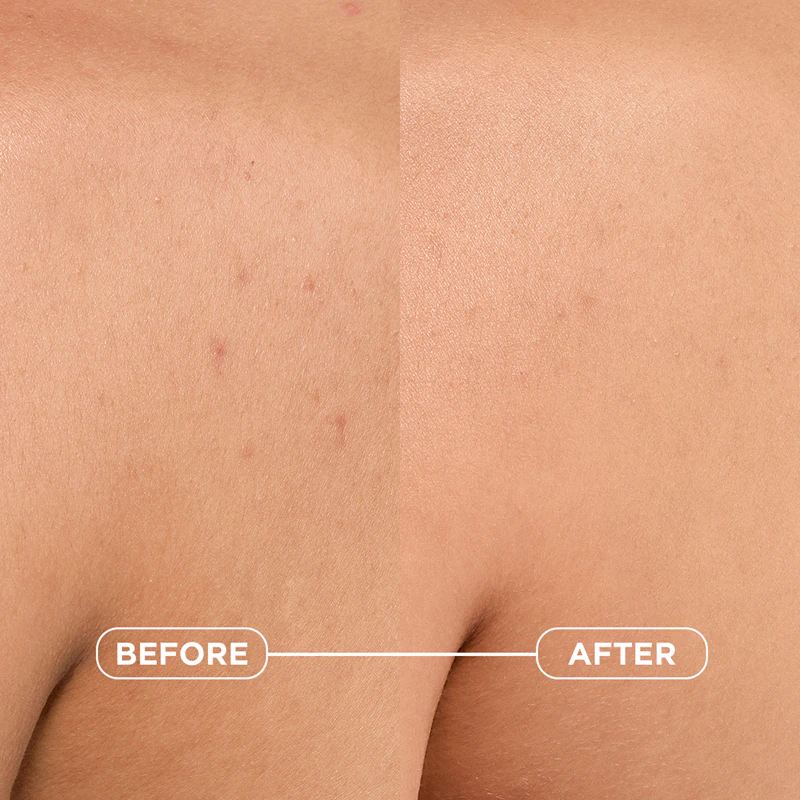 Spray corporal Bioderma Sébium Kerato+ para acne, vermelhidão e cicatrizes de acne.