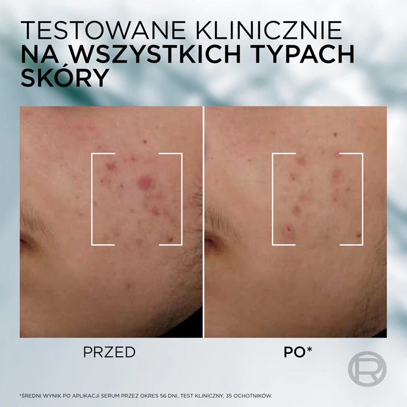 Sérum L'Oréal Paris Men Expert Derma Control contra imperfeições da pele