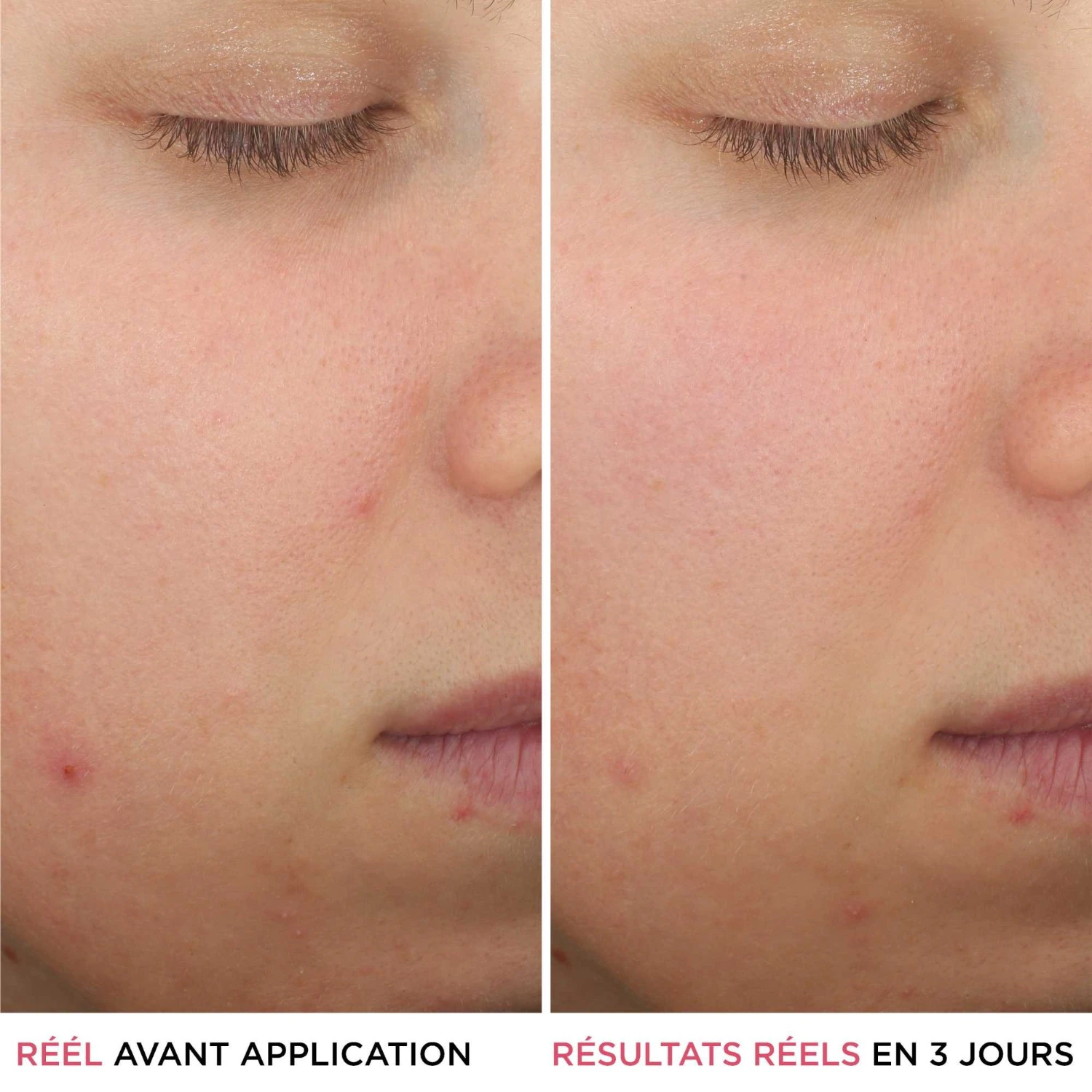 IT Cosmetics Sérum anti-éruptions cutanées à l'acide salicylique