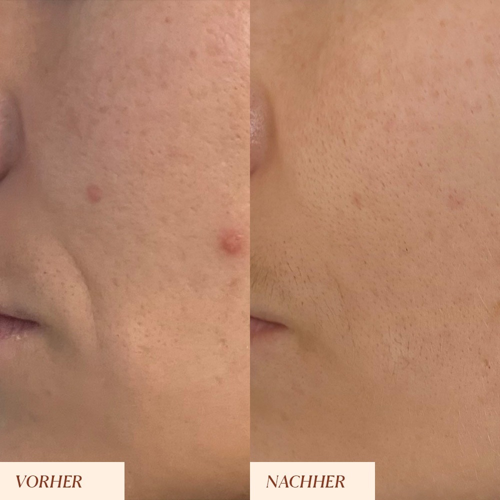 „Junglück“ kremas nuo pigmentinių dėmių ir odos nešvarumų – rutulinis – 5 ml