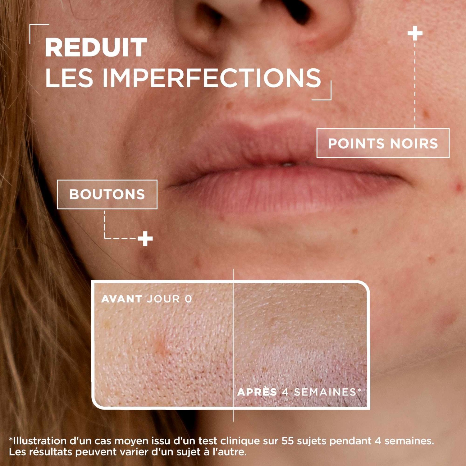 Mixa Sérum Concentré Anti-imperfections