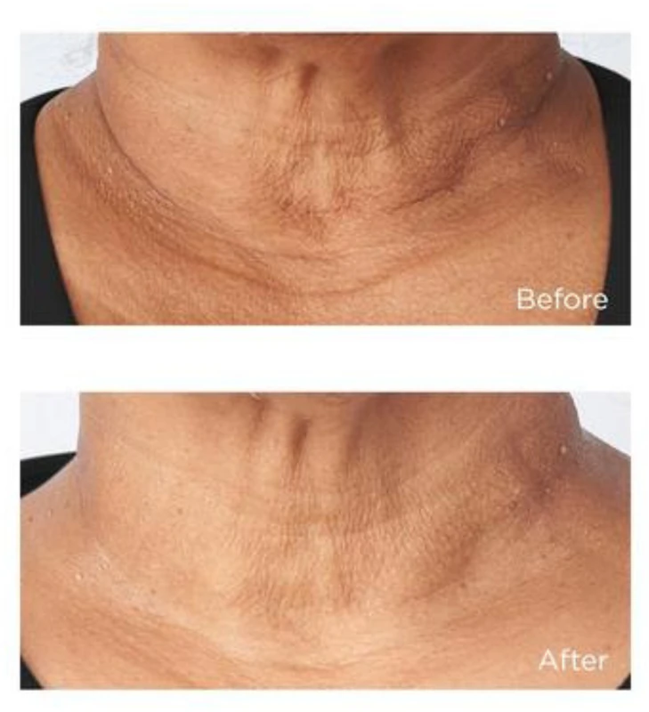 Perricone MD Cold Plasma Plus+ Sub-D/Neck Straffende Creme für Hals und Dekolleté
